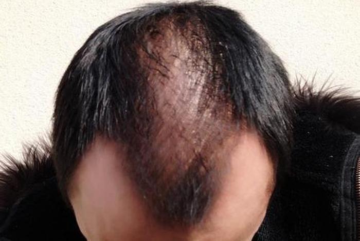 秃顶的历史人物、秃顶名人 秃顶的历史人物、秃顶名人