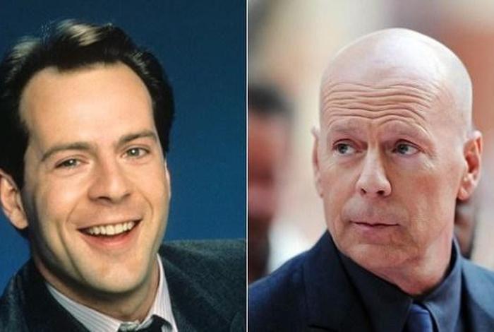 脱发的名人(脱发的故事) 脱发的名人(脱发的故事)