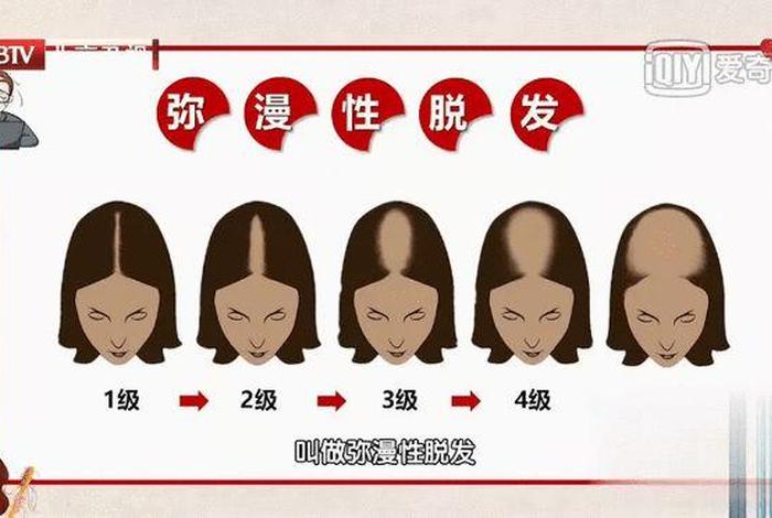 中国的秃头人数 中头概率 中国的秃头人数 中头概率