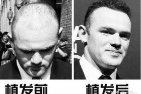 历史上的脱发人群，脱发的原型